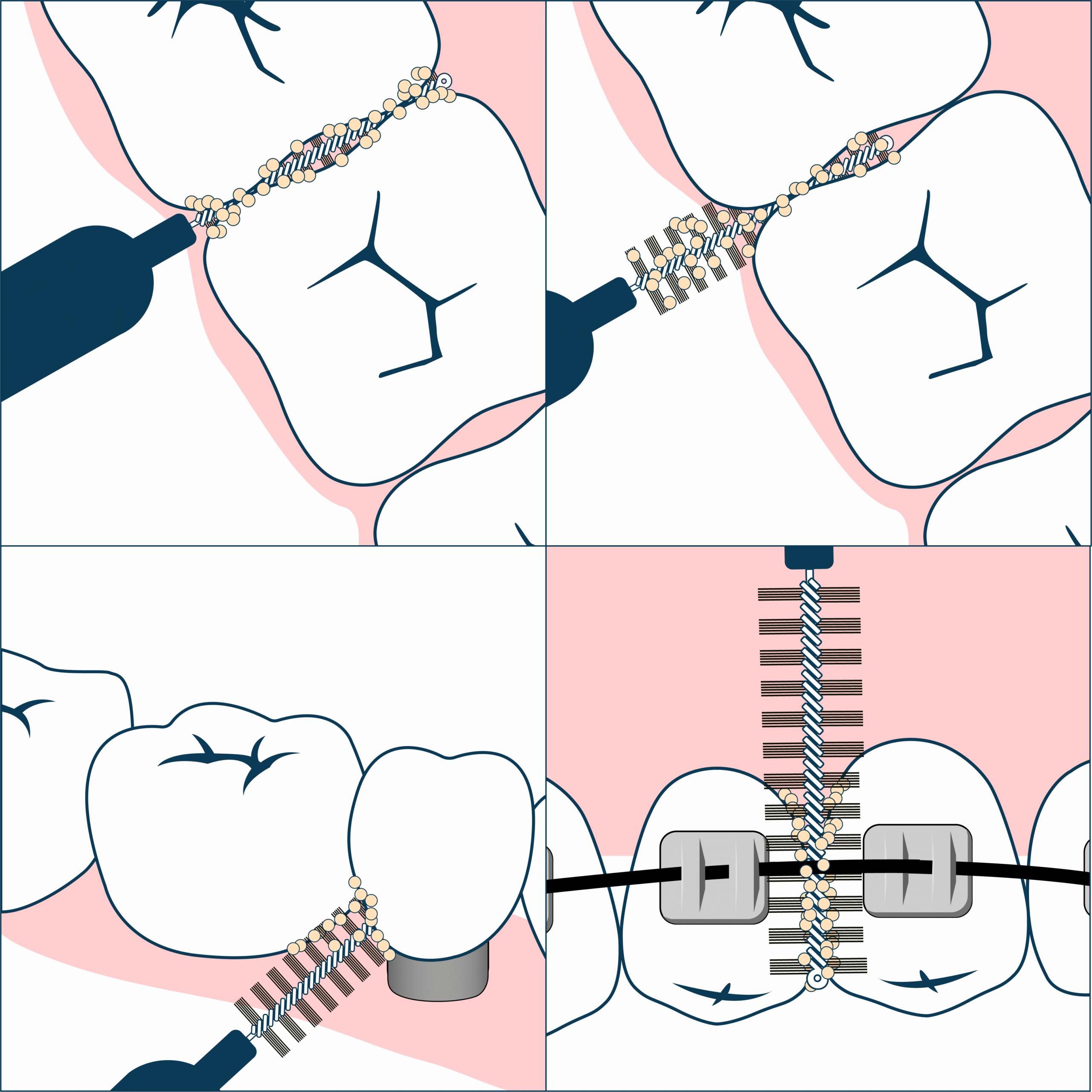 Geldis Scovolino 0,4mm