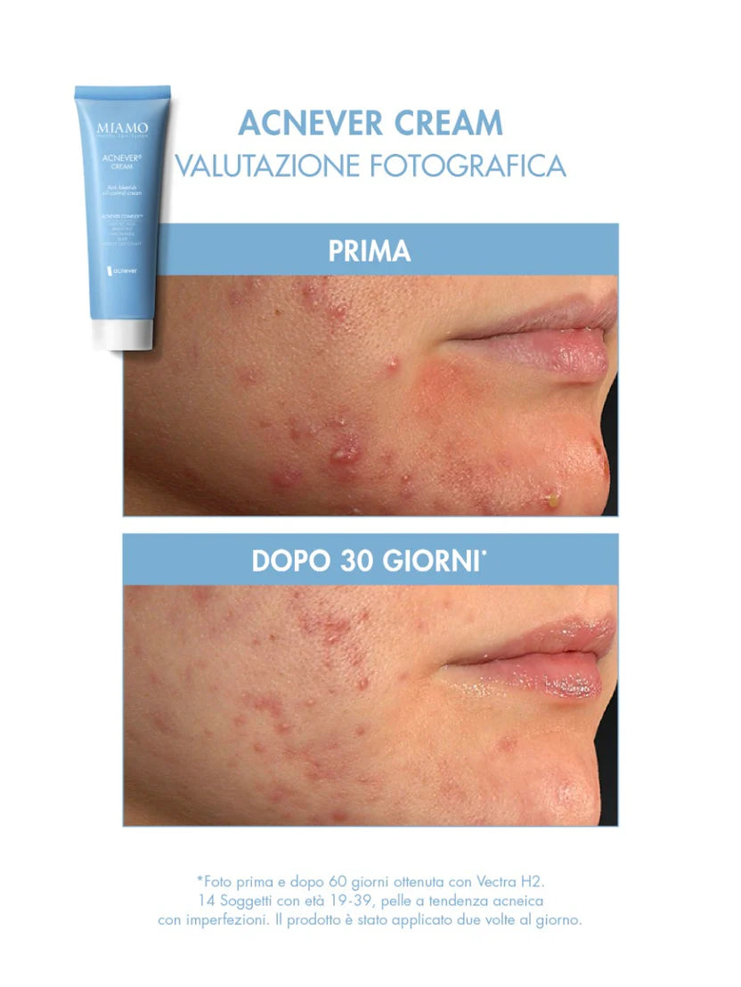 ACNEVER® CREAM anti imperfezioni